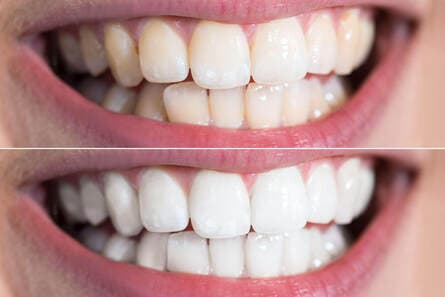 WHITE SMYLE - Dentalhygiene & Bleaching — Zahnarzt in Zürich (Bild 3)