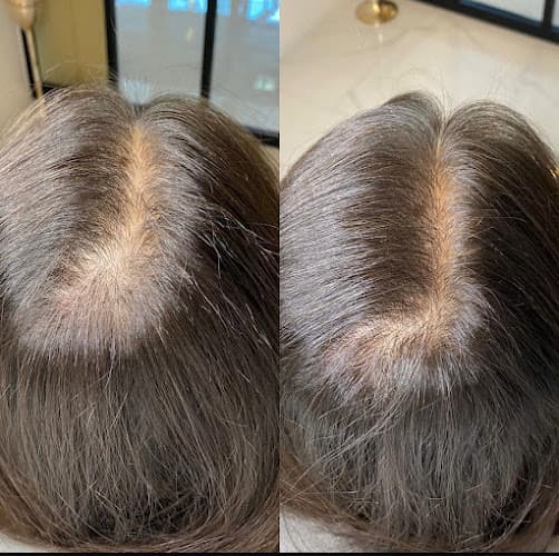 hairbooster - Haarklinik für Haartransplantation | PRP | Mesotherapie — Arzt in Winterthur